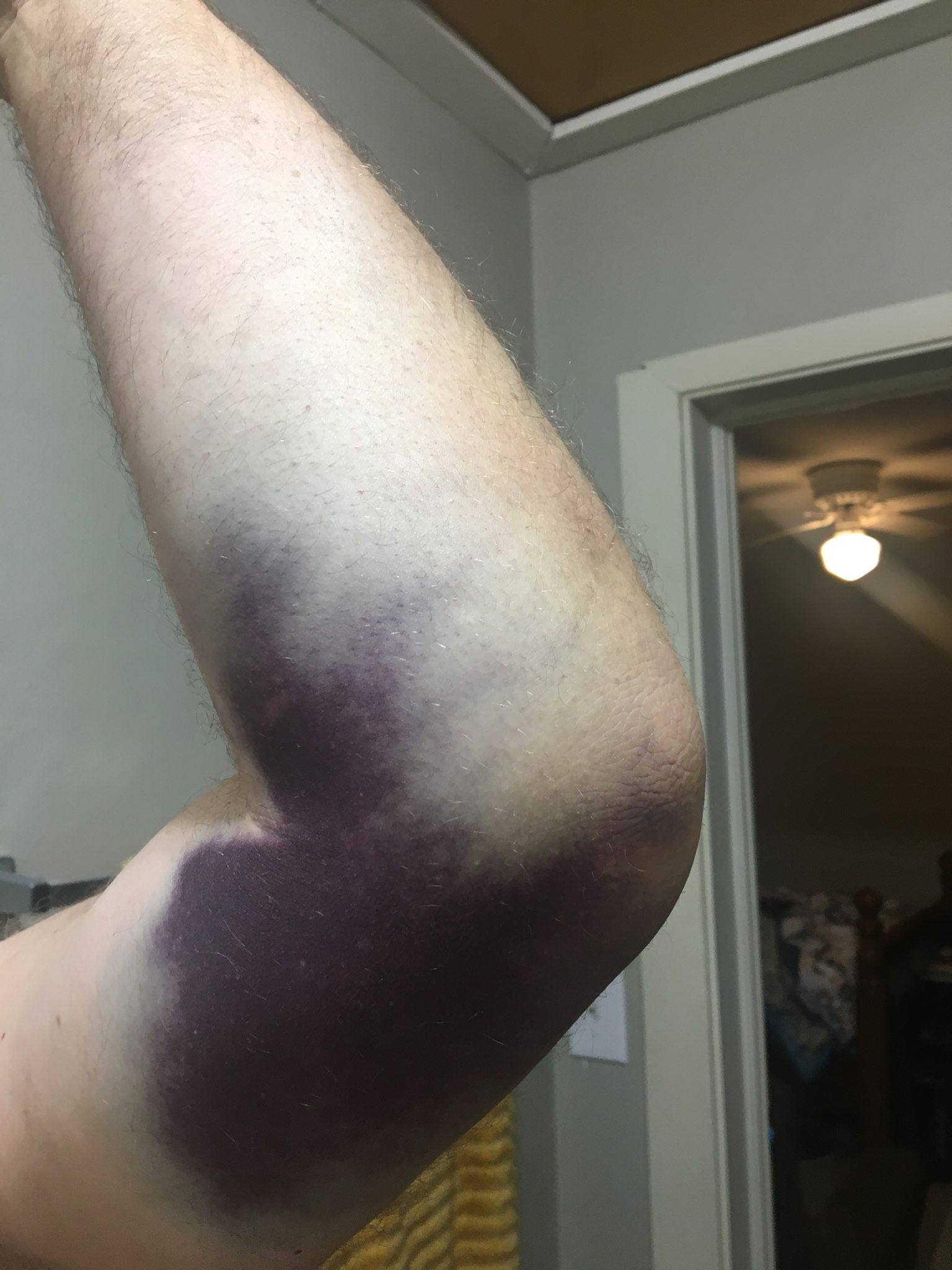Arm injury
